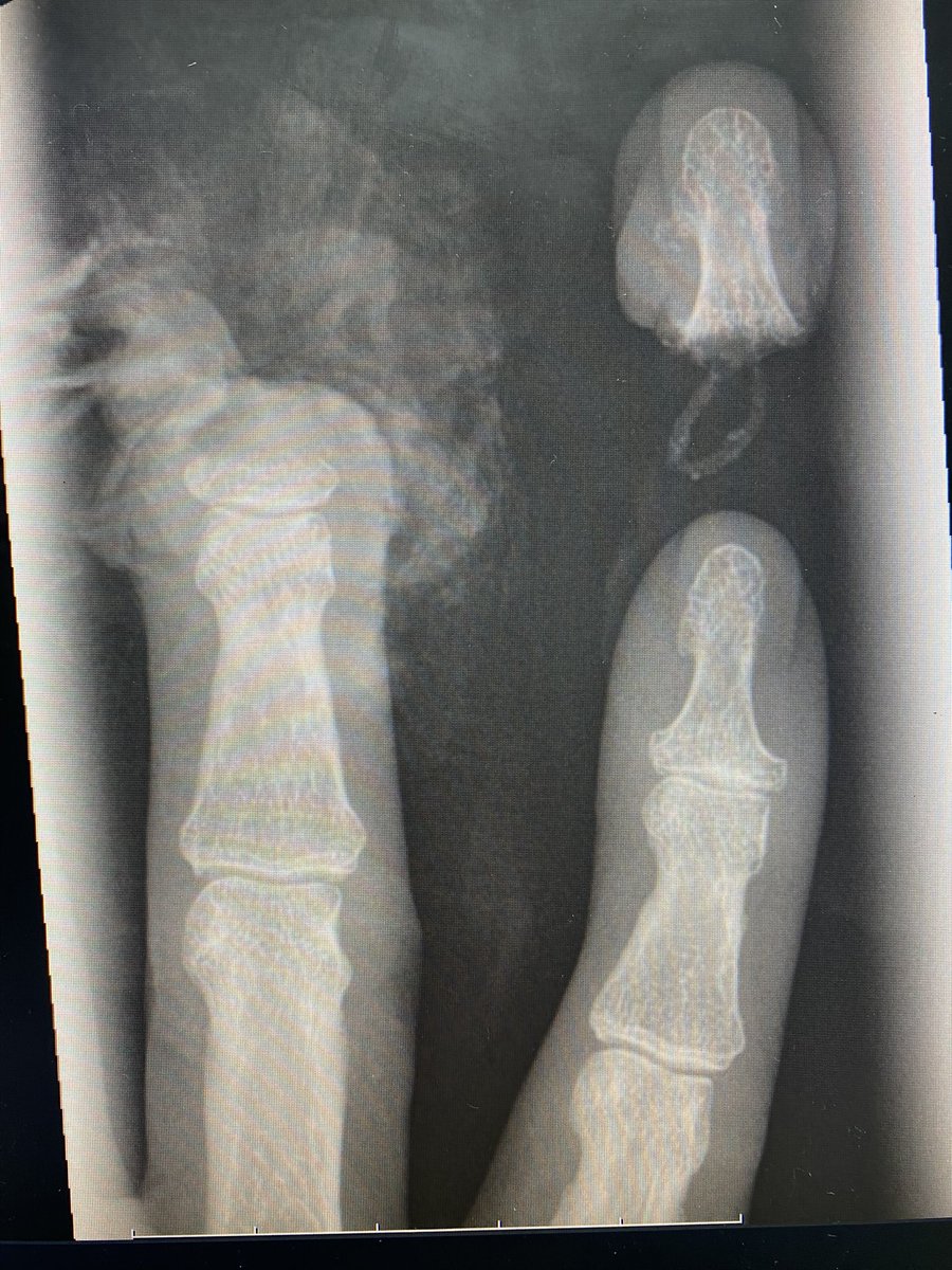 Another op today, can you spot the subtle displacement? 🤔 

#orthotwitter #womeninortho