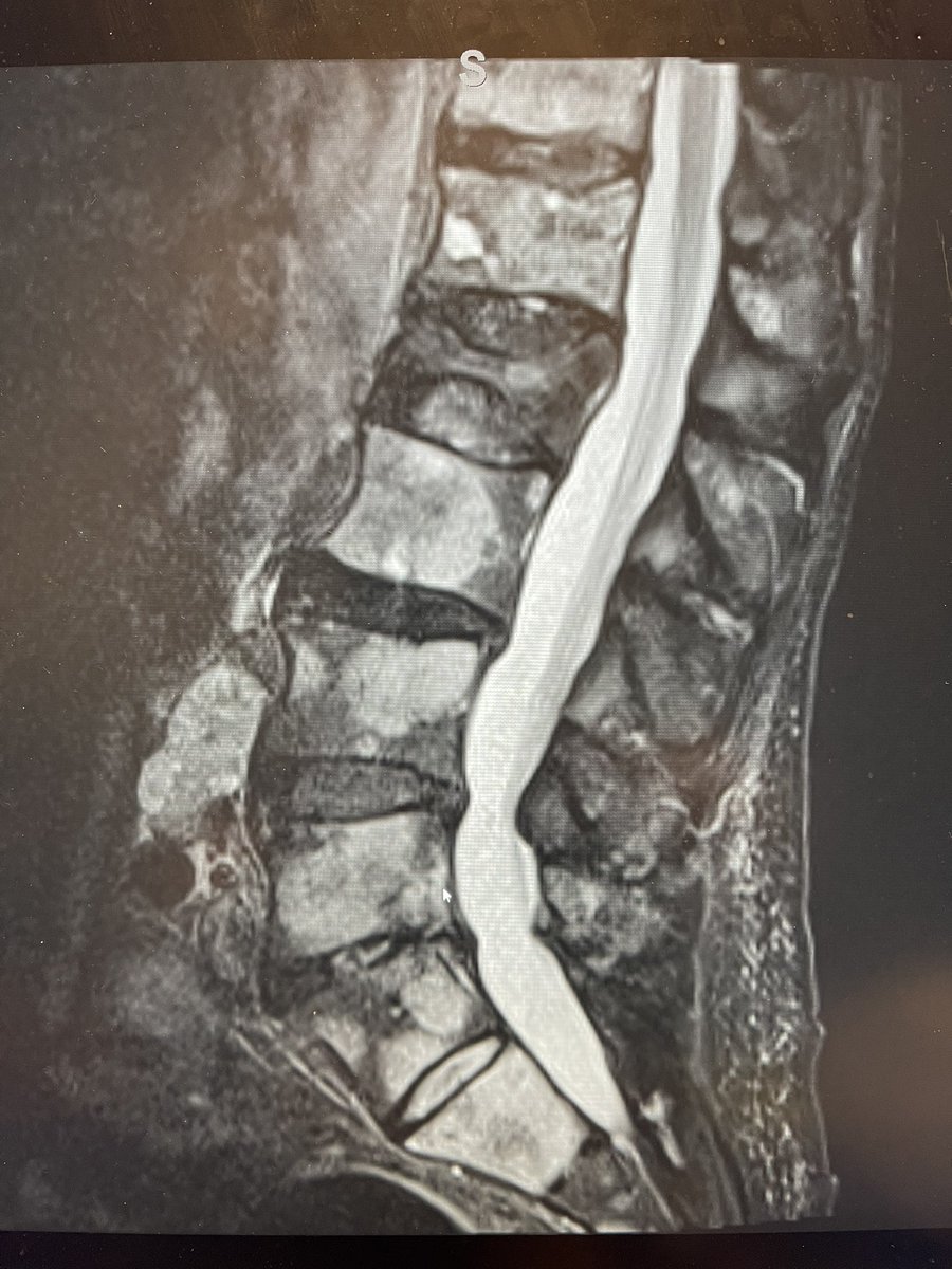 darthglader's tweet photo. More #MSKIR in a man in his 90s. Prior prostatectomy roughly 20 years ago. PSA was 0 ten years ago. Now with widespread metastases and PSA sky-high.
#PathologicFracture at T12. 🧵… https://t.co/a3SCrpZOY7