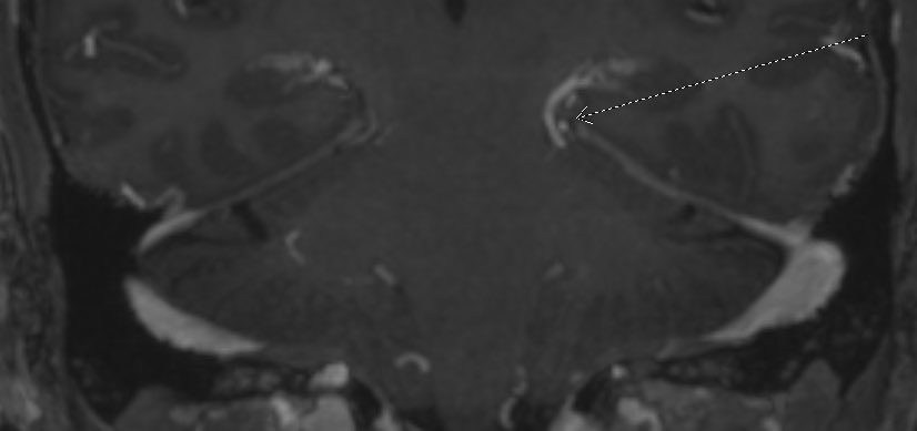 Could it be?! The fabled trochlear nerve cavernoma?! - unproven, but presented with trochlear palsy and all other sequences including MRA/MRV were completely clean. #neuroradiology #Neurology #Neurosurgery #neurotwitter #radres <a href="/ASHNRSociety/">ASHNR</a>