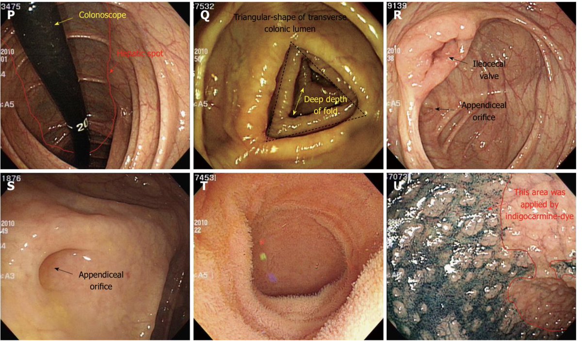 Keith Siau on X: 2) Colonoscopy procedural skills and training