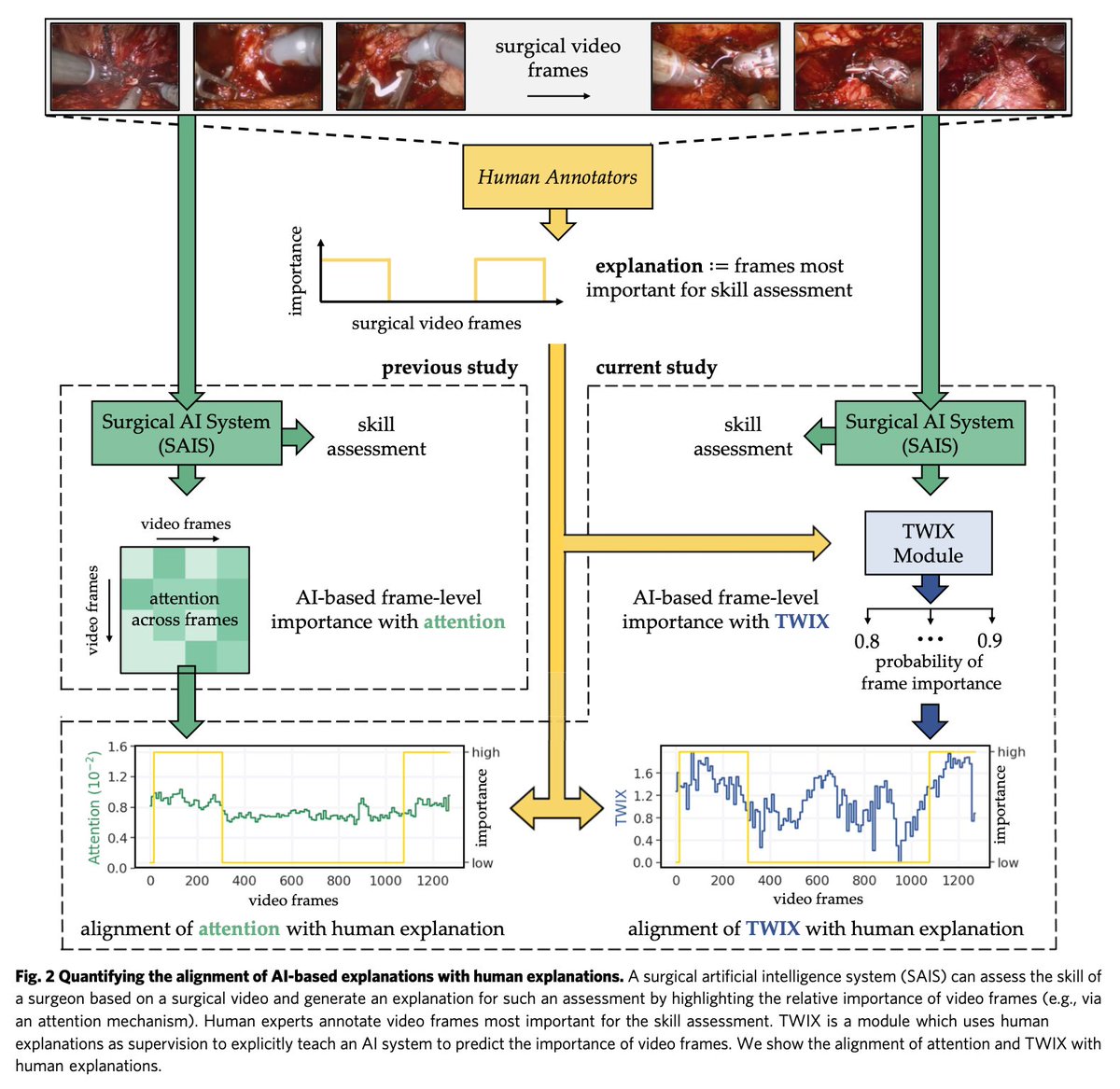 ddonoho's tweet image. Since coaches don&apos;t exist in the OR, surgeons receive less feedback than a 4th-grade basketball player. 

Can an AI system help surgeons improve?

In a three paper series just published 🔥 in @Nature_NPJ, we trained an AI to measure urologic surgery performance.

How did it do?
