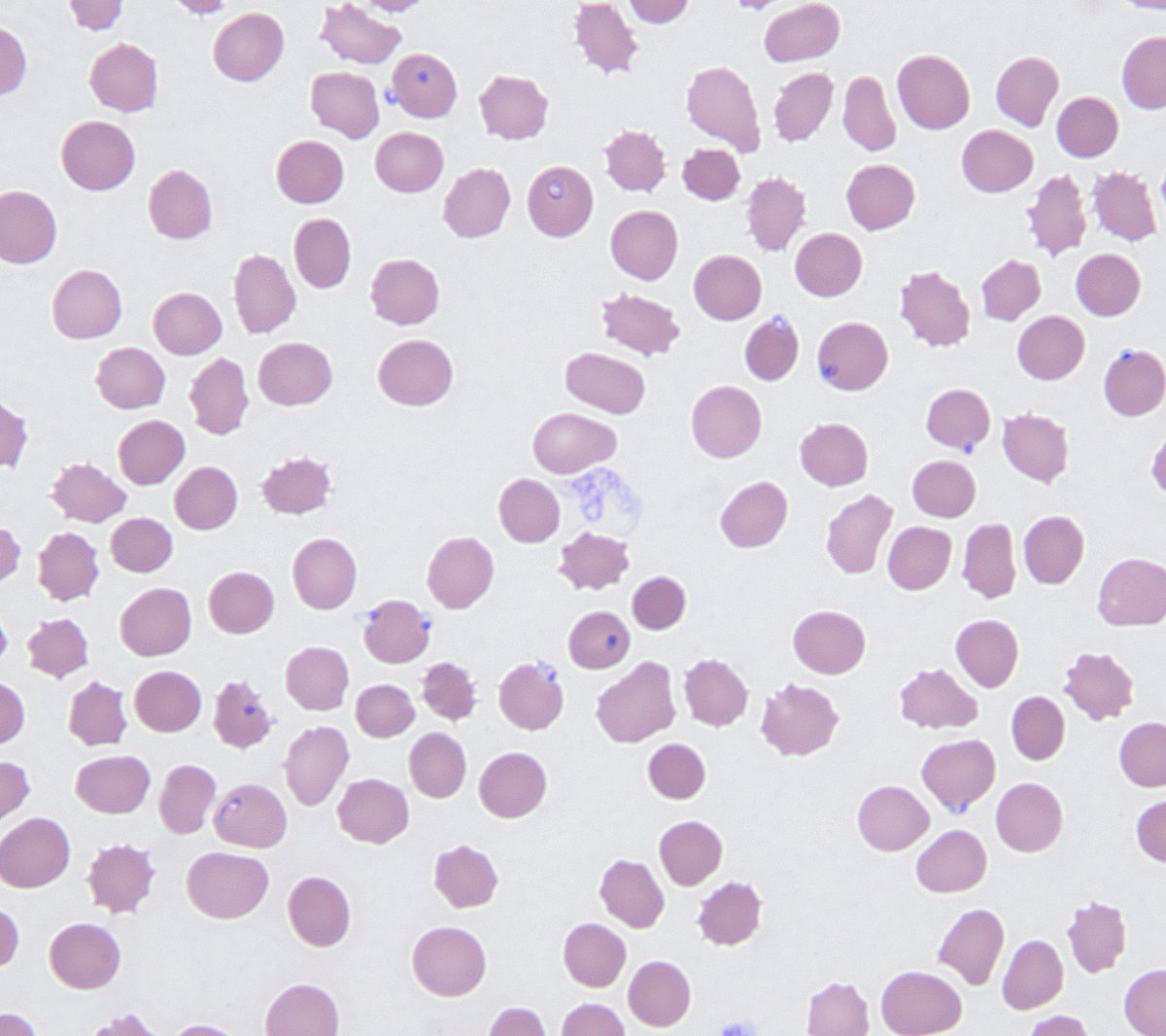Patient presented to the ED 2 weeks after returning from Malawi with fever and AMS. Rapid influenzaA positive
…and then the smears came back…..
1) thick smear
2) thin smear
3) delayed sample-thin smear
#path2path #IDtwitter #tropicalmedicine #clinicalmicro #parasitology