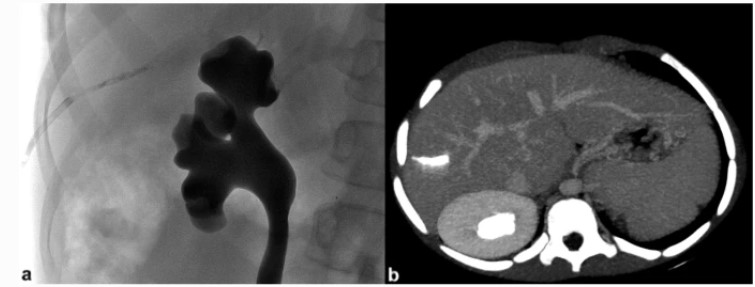 cvirendo's tweet photo. Parenchymal tract embolisation is key since venous bleeding is difficult to control and may require surgical management

Read below to see how different techniques of #haemostasis of the #parenchymal tract compare:
https://t.co/XoCMv6Bopl https://t.co/8tssqeJ8fS