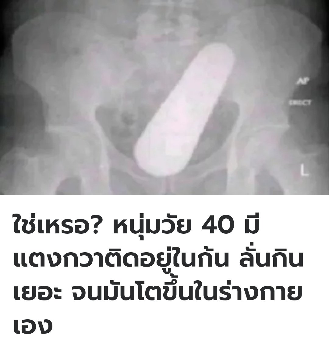 TarotYouuuu's tweet photo. ที่ต่างประเทศ ชายคนนี้มาหาหมอเพราะรู้สึกปวดท้อง เดินไม่ได้ พอตรวจสอบแล้ว เลยพบว่ามีแตงกวาติดในก้นของเขา เจ้าหน้าที่จึงนำออกมาได้ คนไข้มองว่าเขากินแตงกวามากไป เมล็ดแตงกวามันเลยเติบโตขึ้นมาในร่างกายของเขาเองครับ https://t.co/RY5AU1ryel
