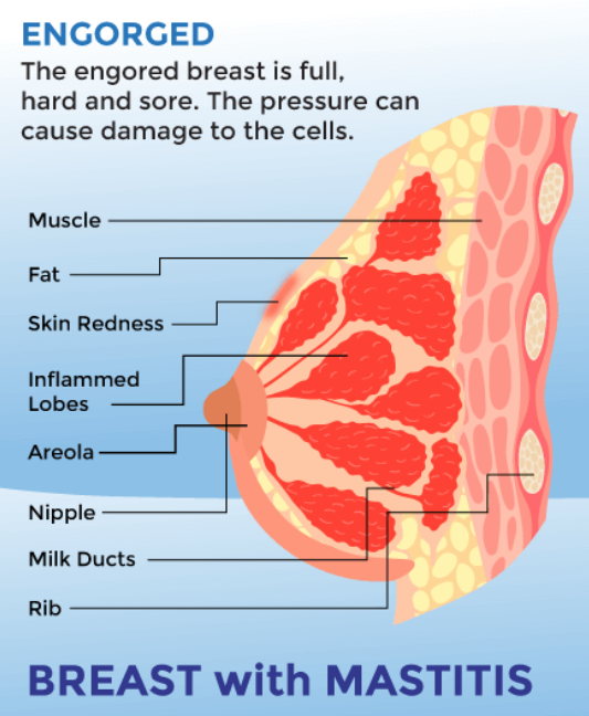 Studying Medicine on Twitter "Lactational mastitis breast