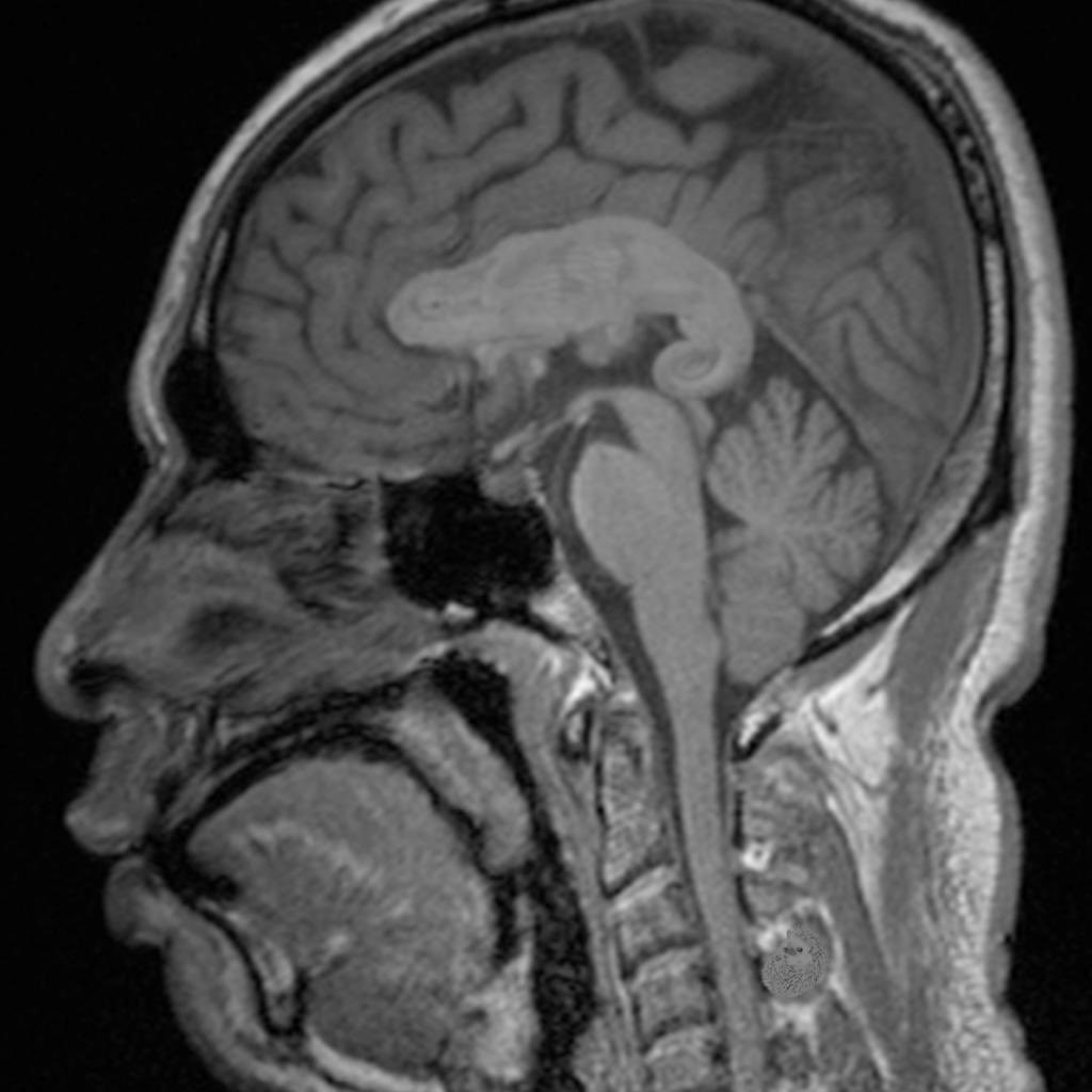 Thoughts? What would your diagnosis be?

Original image courtesy of Dr Ian Bickle, Radiopaedia.org, rID: 52637