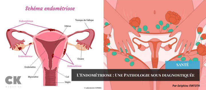 ckomentmagazine's tweet photo. Chaque année, le dernier samedi de Mars est consacré à la sensibilisation sur l’endométriose. Nous revenons aujourd’hui sur cette pathologie sous diagnostiquée. 

Entretien avec @Dr_Mendoo : https://t.co/EiagOjoGa7

#ckoment #EndometriosisAwarenessMonth https://t.co/M7GfFGV47l