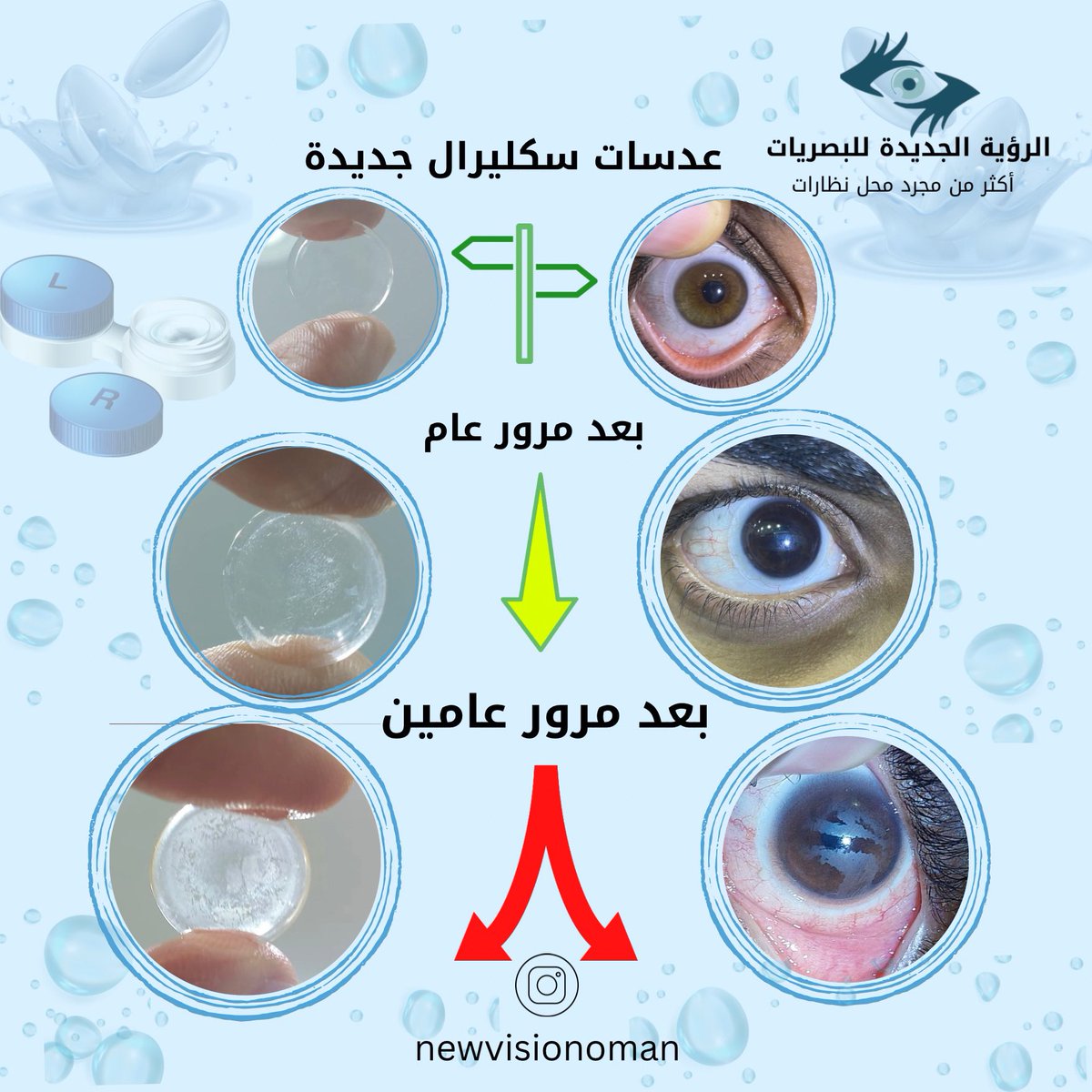 ntoosh's tweet photo. لمستخدم #عدسات  #السكليرال المخصصة لمرضى #القرنية_المخروطية احرص على استخدام المحاليل المخصصة للعنايه بهذه النوعية الخاصة من #العدسات وتجنب استخدامها لقترة اطول من متوسط عمرها الافتراضي والذي يتراوح بين عامين وثلاثة اعوام كحد اقصى ، مع الالتزام بالمراجعه الدورية عند المختص ،، https://t.co/rvXR4jCVFr