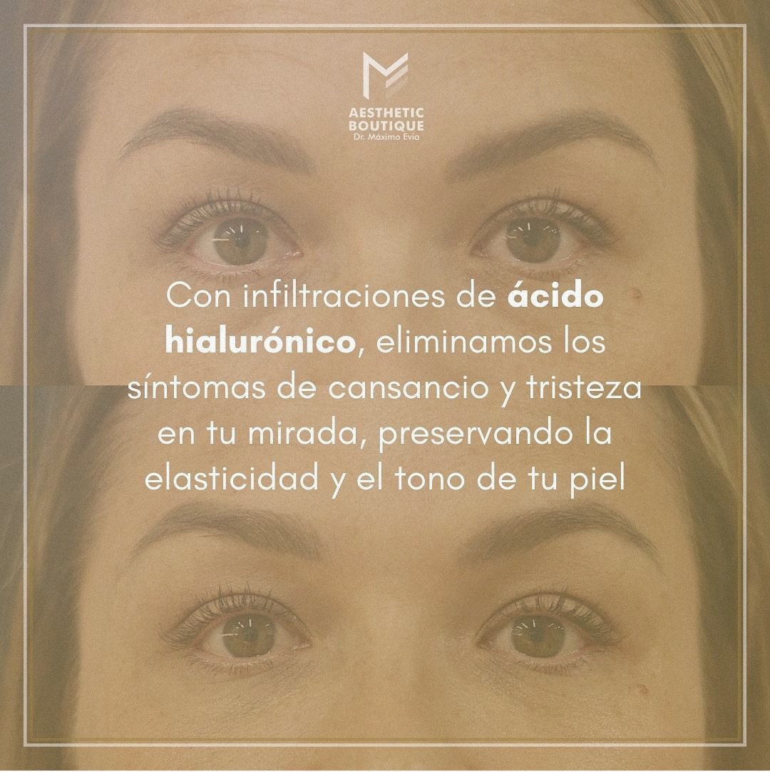 abmaximoevia's tweet photo. 🙈 ¿Cansada de tu mirada cansada?

¡Atrévete a lucir una mirada más fresca y juvenil! ✨👁️👁️🌷

#Ojera #ÁcidoHialurónico #TercioMedio #MedicinaEstética #Madrid #BarrioSalamanca #Antiaging #ArquitecturaFacial #Belleza #MiradaCansada #Ojos #Estética #AestheticBoutique #MáximoEvia https://t.co/FJSVXlUpQv