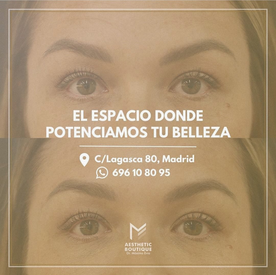 abmaximoevia's tweet photo. 🙈 ¿Cansada de tu mirada cansada?

¡Atrévete a lucir una mirada más fresca y juvenil! ✨👁️👁️🌷

#Ojera #ÁcidoHialurónico #TercioMedio #MedicinaEstética #Madrid #BarrioSalamanca #Antiaging #ArquitecturaFacial #Belleza #MiradaCansada #Ojos #Estética #AestheticBoutique #MáximoEvia https://t.co/FJSVXlUpQv