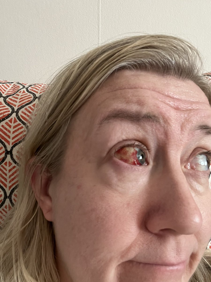 kickinorman's tweet photo. Vi kan väl beundra mitt spruckna blodkärl en minut? https://t.co/tp7JMkQMzG