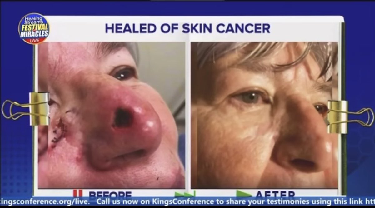 HSTV_'s tweet photo. Healed of skin cancer during the Healing Streams Live Healing Services with Pastor Chris! Glory!🥳

Join the ongoing Healing Streams Festival of Miracles. Log on and invite everyone around you to participate Live on https://t.co/UmFi2dzw0V

#healingstreams
#healingtothenations https://t.co/TPFE5bkWjT