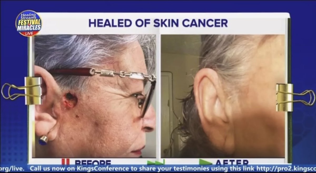 HSTV_'s tweet photo. Healed of skin cancer during the Healing Streams Live Healing Services with Pastor Chris! Glory!🥳

Join the ongoing Healing Streams Festival of Miracles. Log on and invite everyone around you to participate Live on https://t.co/UmFi2dzw0V

#healingstreams
#healingtothenations https://t.co/TPFE5bkWjT