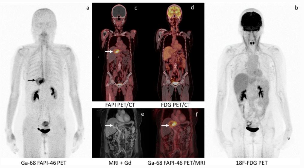 IMAGE OF THE MONTH: On the 1st of each month, we would like to highlight the great work in MIB! This April, the Image of the Month shows PET-CT detection of intrahepatic tumors. Read Siripongsatian et al.'s work: ow.ly/k4Co50NwAFH