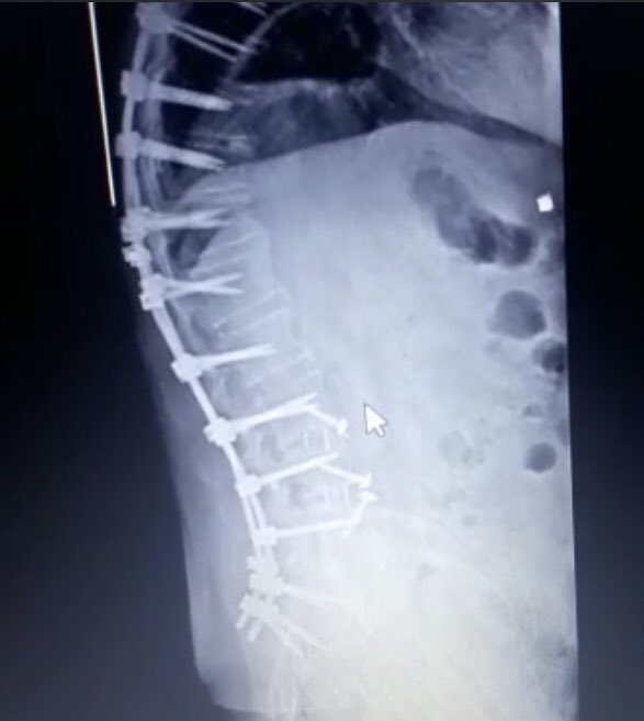 natashaaquela's tweet photo. Imagina vc ter mais de 2 metros de altura e sofrer com cifose (desvio da coluna), chegar andando no hospital pra fazer uma cirurgia de correção e alem de não resolver a doença, por um erro médico (imperícia, impudência)vc quase morre e está na cama, sem andar há mais de um ano? https://t.co/GT0HRjopJ8