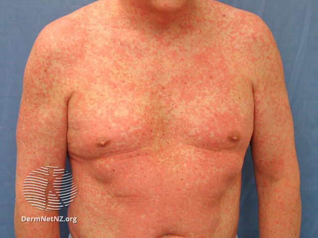 I've resisted long enough but it's finally time:

A #tweetorial on the MACULOPAPULAR RASH!

#MedEd #FOAMEd #dermtwitter #medtwitter 

1/