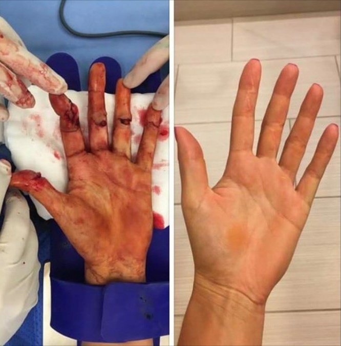 DriveCruzado's tweet photo. Petra Kvitova (🇨🇿) en diciembre del 2016 había sido atacada en su domicilio y recibió heridas de gravedad en su mano izquierda. Su futuro como jugadora era incierto pero nunca se rindió y hoy nuevamente nos demostró de que está hecha.

Gracias Petra por tanto amor al tenis 🎾 https://t.co/RgunV9Qre1
