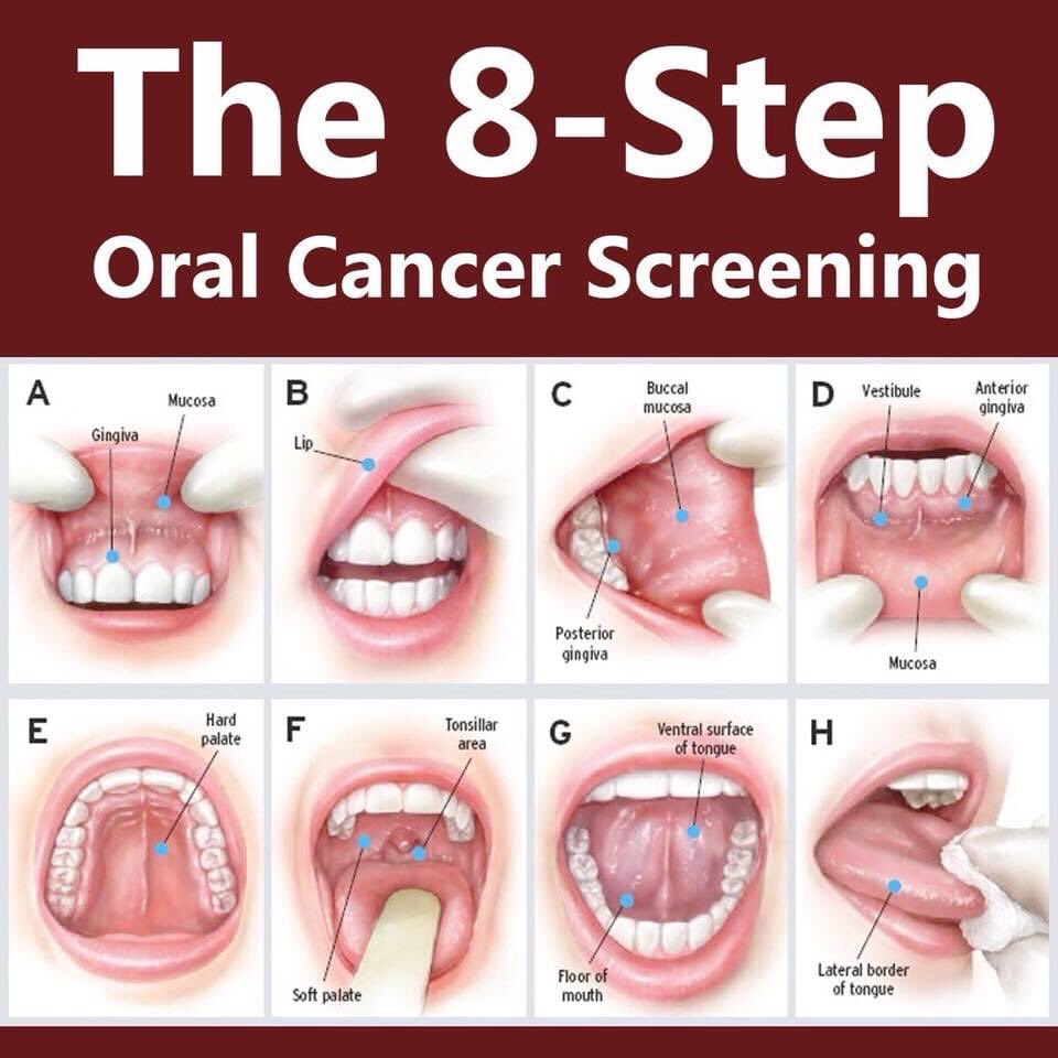 *April is #OralCancerAwareness month.* Major risk factors: smoking, tobacco use, Human papillomavirus (HPV). #HPV is thought to cause 70% of oropharyngeal cancers in the United States.👄🦷👅 
#DentalGroupatRestonStation #OralCancer #ThroatCancer #OropharyngealCancer #HPVVaccine