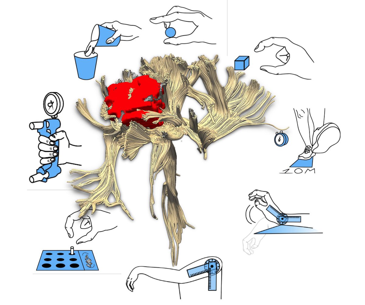 Brain1878's tweet photo. Talozzi et al. report that long-term stroke symptoms can be predicted individually based on acute clinical neuroimaging with a mean absolute error below 20%, and provide the first atlas of disconnectome-deficit relationships. https://t.co/6KE6VZ2KiJ https://t.co/UyoPh3C2LZ