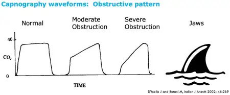 AvrahamCooperMD's tweet photo. Cool #zentensivism tip: 

End tidal C02 waveform correlates with bronchoconstriction in status asthmaticus on the vent. 

Transition from shark fin to square wave = resolution of bronchospasm 

#MedTwitter https://t.co/F0AUWe6L33