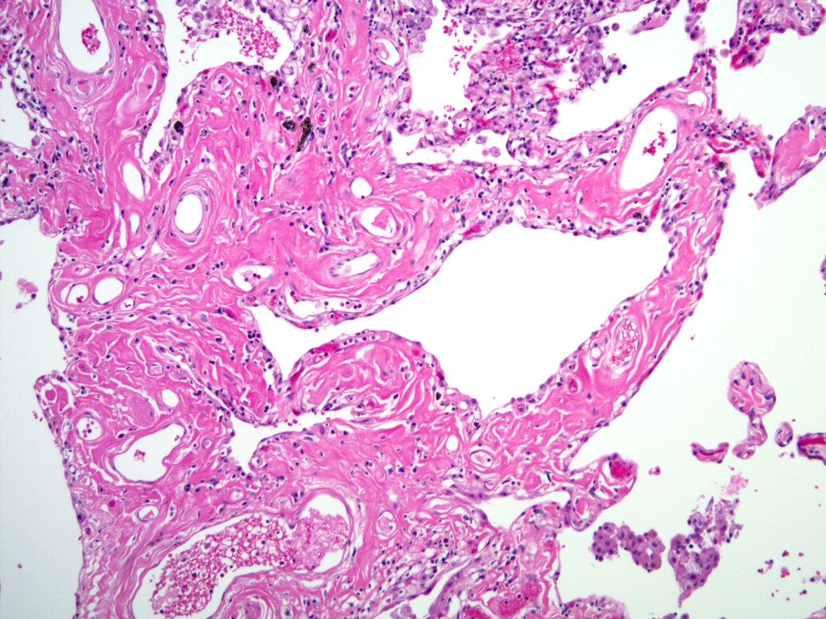 smlungpathguy's tweet photo. SRIF is a histologically distinctive form of interstitial lung disease caused by smoking: #srif #smoking #pulmpath #pathology https://t.co/tZQhsHv1RV https://t.co/Egy3RJvlSt