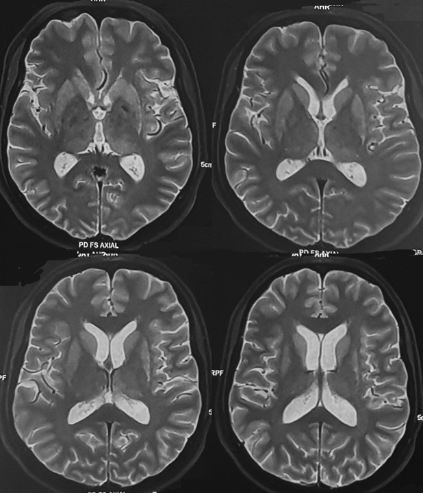 Suvorit Bhowmick (@suvorit_b) on Twitter photo A 60-year-old lady has asymmetric parkinsonism for the past 2 years. She has moderate-to-severe rigidity and moderate bradykinesia of right hand, while on levodopa 750 mg/day. See the MRI below. The radiologist reported it normal. Is it?
#Parkinsonsdisease A 60-year-old lady has asymmetric parkinsonism for the past 2 years. She has moderate-to-severe rigidity and moderate bradykinesia of right hand, while on levodopa 750 mg/day. See the MRI below. The radiologist reported it normal. Is it?
#Parkinsonsdisease