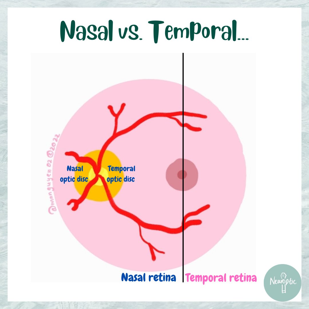 NeuropticEd's tweet image. The #retina is divided into nasal and temporal based on location from the #fovea. The #opticdisc is divided into superior, inferior, nasal and temporal portions, but the whole disc is in the nasal retina. 
Nasal retina -&amp;gt; temporal field
Temporal retina -&amp;gt; nasal field

#MedEd