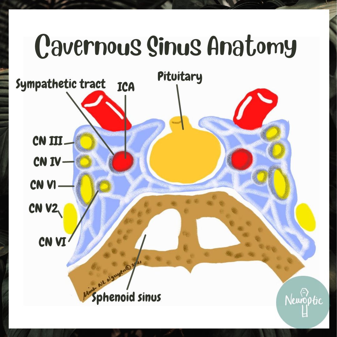 NeuropticEd's tweet photo. #TolosaHunt syndrome refers to inflammation of the #cavernoussinus - causing periorbital pain and #ophthalmoplegia. It is very steroid responsive.
Consider alternate causes - it is a diagnosis of exclusion.
#MedEd #neuroanatomy #Neurology #ophthalmology https://t.co/ct5SYoyeCT