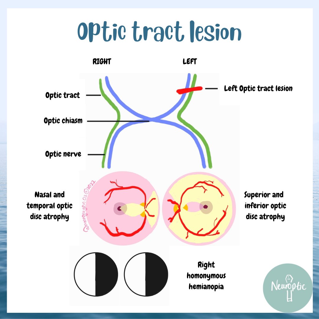 NeuropticEd's tweet photo. Optic tract lesions cause contralateral homonymous hemianopia. The contralateral side (temporal VF loss) has bow tie atrophy (nasal/temporal optic disc thinning) while the ipsilateral side (nasal VF loss) has hourglass atrophy (superior/inferior optic disc thinning)

#MedEd https://t.co/RAOK7cONO3