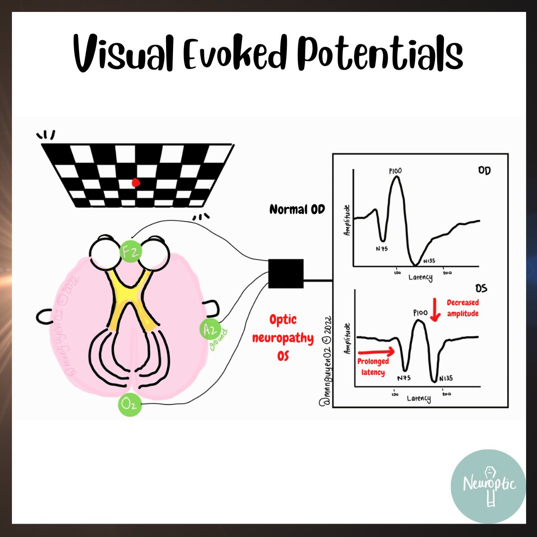 NeuropticEd's tweet photo. #VEP reflects visual cortex responses to visual stimuli.

Abnormal visual pathway (eg. optic neuropathy) maybe cause slower (prolonged latency) or smaller (lower amplitude) response or both.

Drowsiness, functional vision loss, not wearing glasses can cause abnormal VEPs

#MedEd https://t.co/XYKGTsu980