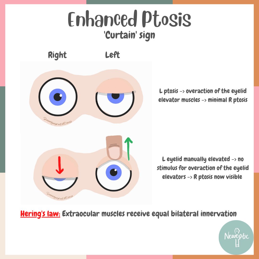 NeuropticEd's tweet photo. Enhanced ptosis / 'curtain' sign can identify bilateral ptosis where there is asymmetry, and the milder #ptosis might otherwise be missed. Manually elevating the more affected eyelid can unmask the other eye ptosis. This can be a sign of #MG / #LEMS.

#MedEd #Neurology https://t.co/0L8cQi5OTl