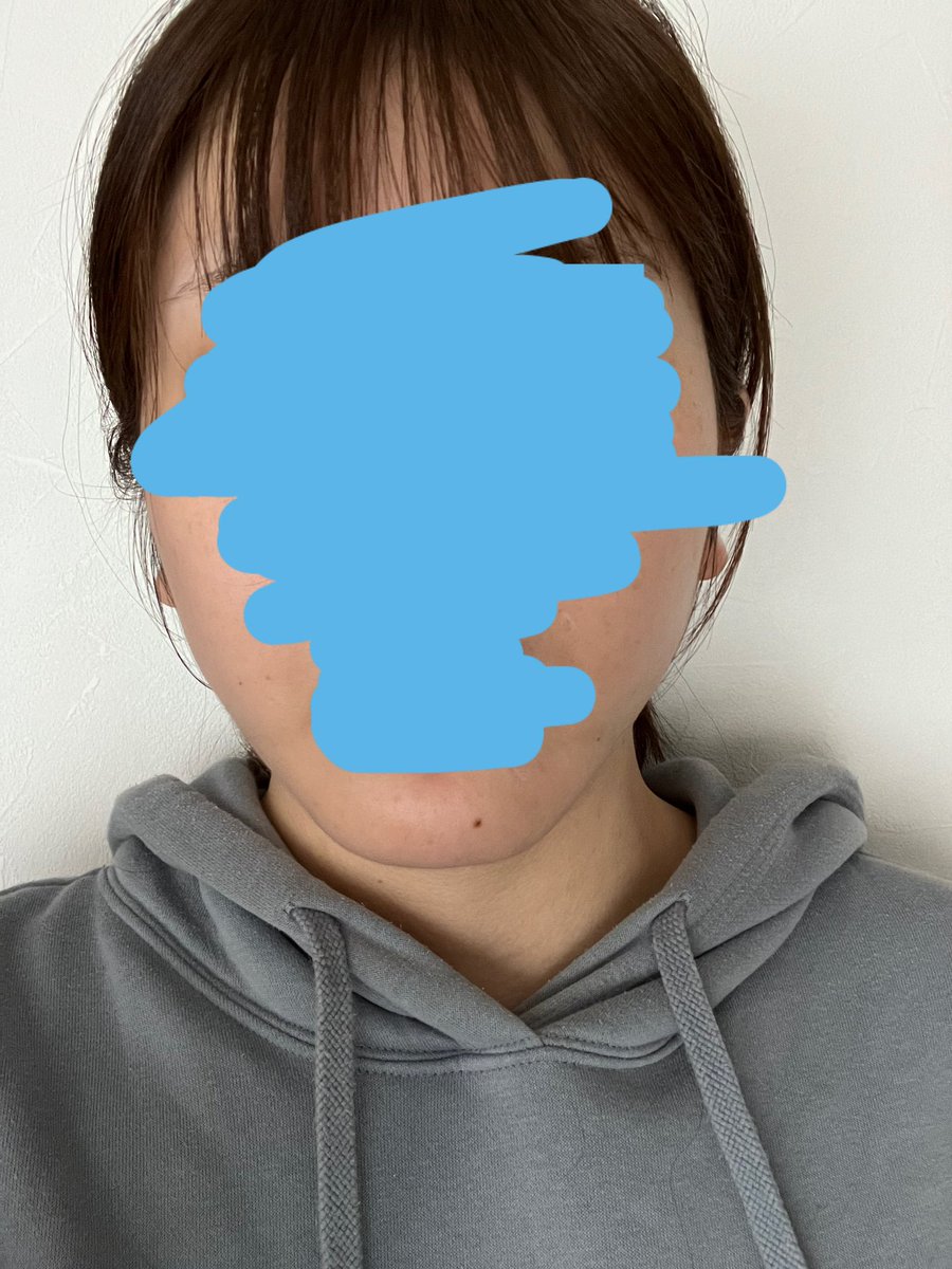 cw5_d0's tweet photo. 3ヶ月経った〜
まだぼこぼこしてるところはあるけど大分なくなってきて、気になってた口横の線もほぼなくなりました！拘縮は首がまだめちゃくちゃキモい https://t.co/P8rZaWyN1g
