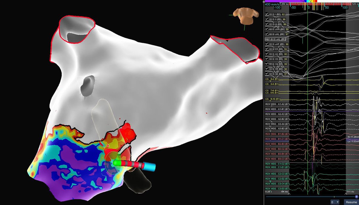 mertilkerh's tweet photo. Epicardial concealed accessory pathway ablation; I could not ablate it in the previous attempt since the patient’s SVT turns to AF very fast during conventional mapping even there was a thrombus in LAA which prevented us to perform IAS puncture. This time he is under amio+NOAC https://t.co/602NAPXZRv
