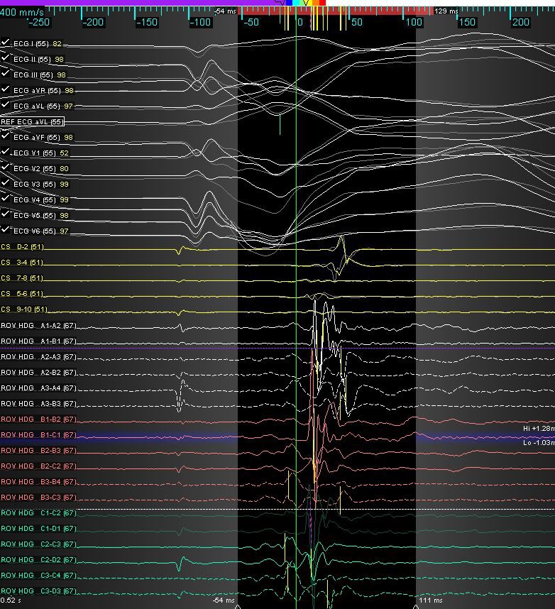 mertilkerh's tweet photo. Epicardial concealed accessory pathway ablation; I could not ablate it in the previous attempt since the patient’s SVT turns to AF very fast during conventional mapping even there was a thrombus in LAA which prevented us to perform IAS puncture. This time he is under amio+NOAC https://t.co/602NAPXZRv