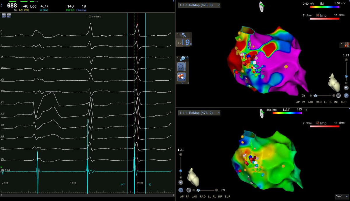 ACH_epteam's tweet photo. ''The width of life is more important than the length of life ''  Avicenna / İbn-i Sina  #ECG  @YakutIdris @hcnknt @Mkara_EP @DuyguKocyigitMD @ElifhandeMD @AhmetKorkmaz07A @ozcanozeke @EF_Cardiaca @drfiratozcan @prof_serkan_cay @DursunAras2 @topaloglu_prof https://t.co/pfoGYyWhee https://t.co/WRhYsYIHY3
