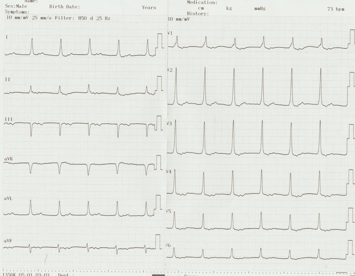 ACH_epteam's tweet photo. ''The width of life is more important than the length of life ''  Avicenna / İbn-i Sina  #ECG  @YakutIdris @hcnknt @Mkara_EP @DuyguKocyigitMD @ElifhandeMD @AhmetKorkmaz07A @ozcanozeke @EF_Cardiaca @drfiratozcan @prof_serkan_cay @DursunAras2 @topaloglu_prof https://t.co/pfoGYyWhee https://t.co/WRhYsYIHY3