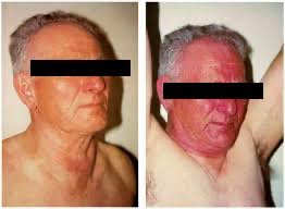 drkeithsiau's tweet photo. Patient with Crohn’s disease presents with facial redness on lifting his arms. What’s the diagnosis? https://t.co/UMJNQaYFM6