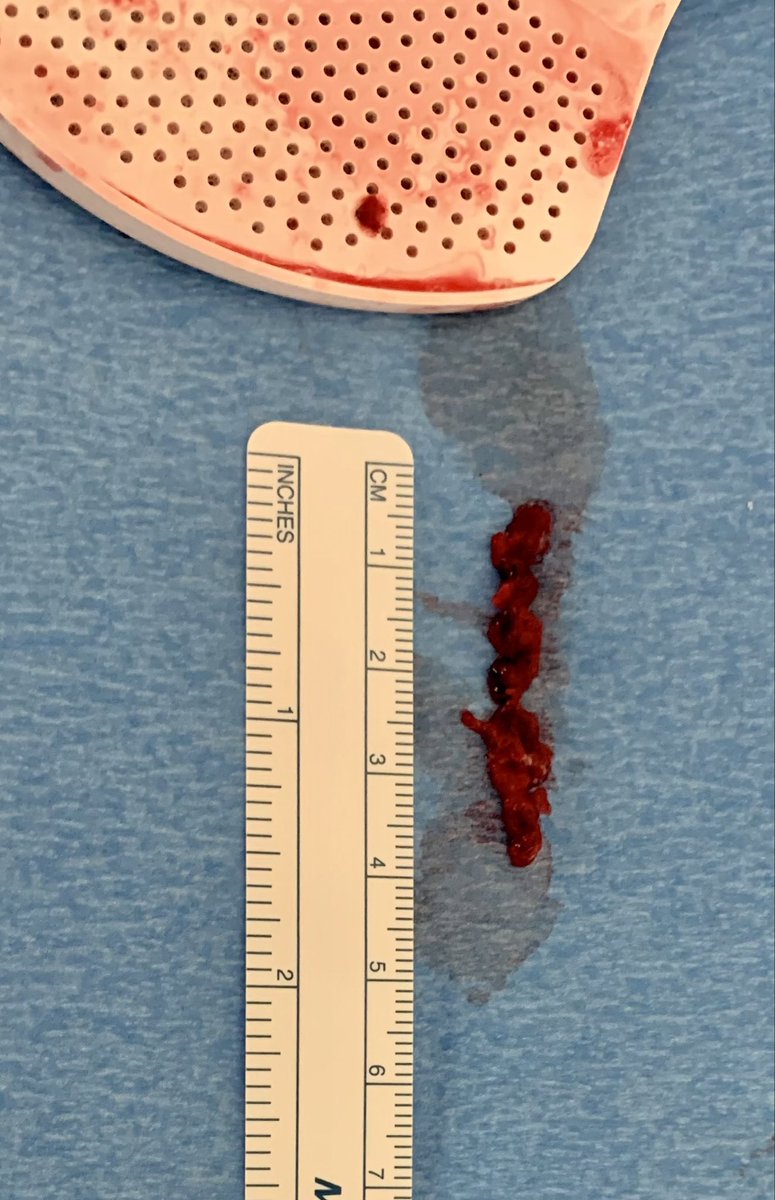 RMotaganahalli's tweet photo. Acute Superior Mesenteric Artery occlusion while off anticoagulation. Mechanical thrombectomy with @penumbrainc Bolt . One more treatment option besides an embolectomy https://t.co/H0Dpg9EM8f