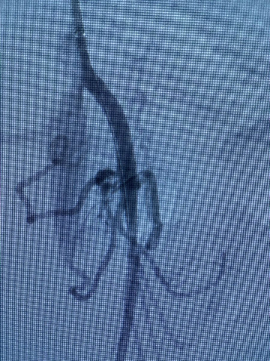 RMotaganahalli's tweet photo. Acute Superior Mesenteric Artery occlusion while off anticoagulation. Mechanical thrombectomy with @penumbrainc Bolt . One more treatment option besides an embolectomy https://t.co/H0Dpg9EM8f