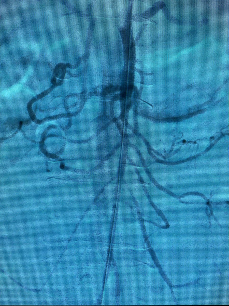 RMotaganahalli's tweet photo. Acute Superior Mesenteric Artery occlusion while off anticoagulation. Mechanical thrombectomy with @penumbrainc Bolt . One more treatment option besides an embolectomy https://t.co/H0Dpg9EM8f