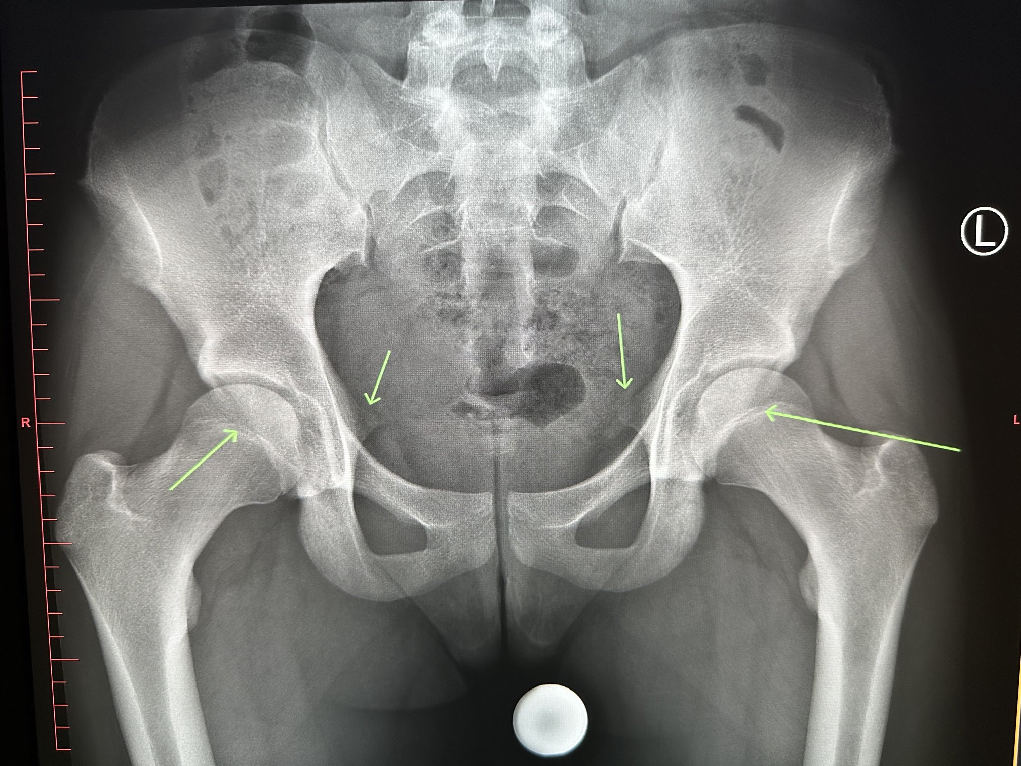 Cpt Code For Ischial Bursa Injection: What You Need To Know - r2sqd0y