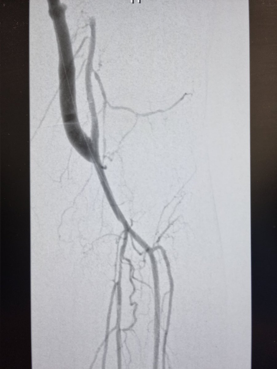 The beauty of a vein bypass is undeniable - even at 3am in the morning! #vascular #vascularsurgery #surgery #limbsalvage #CLTI