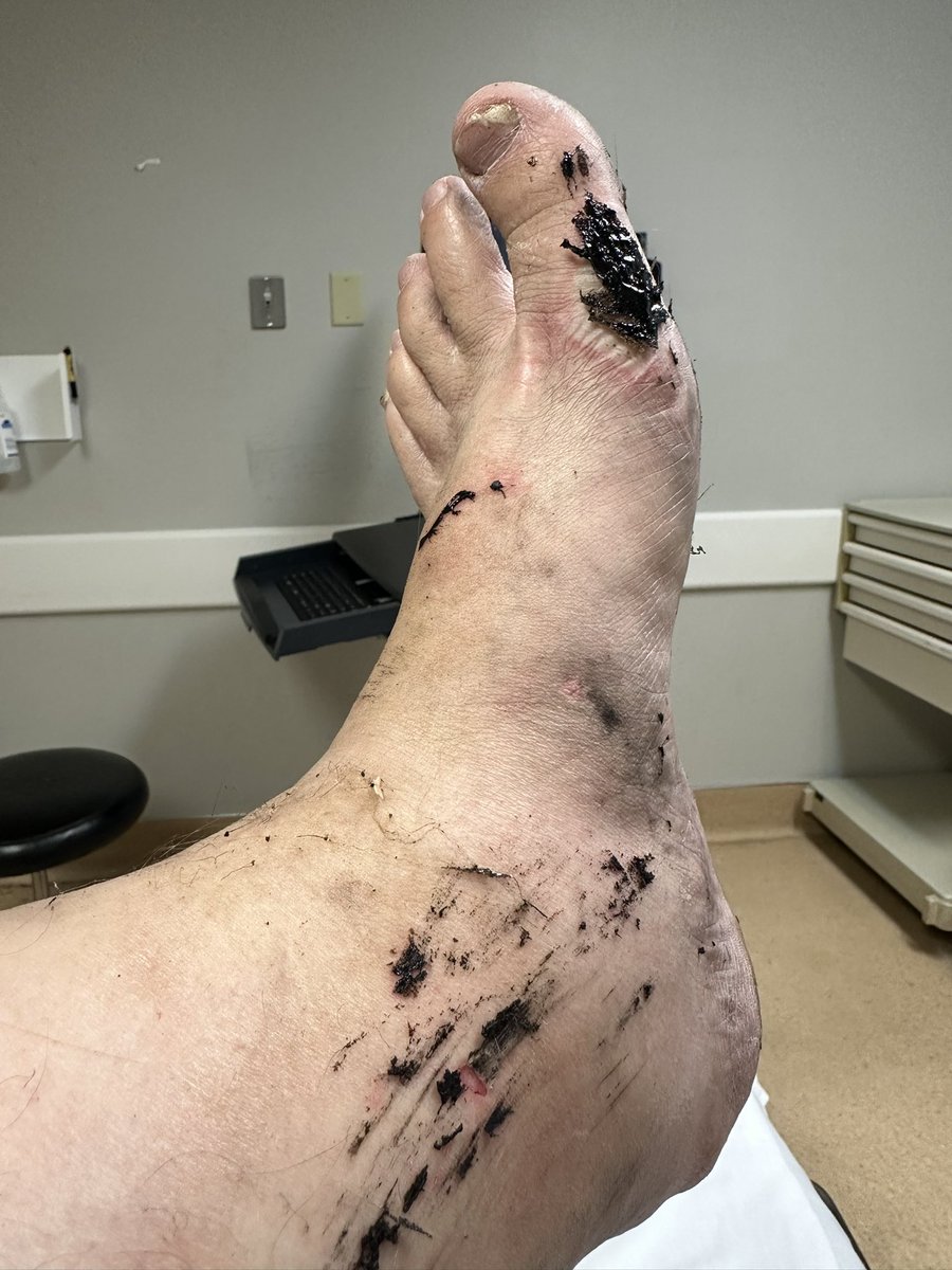 TPolehn's tweet image. Fucked around found out putting fire 🔥 out in flip flops 🩴 not a good idea.  #FAFOLife #ItsScience