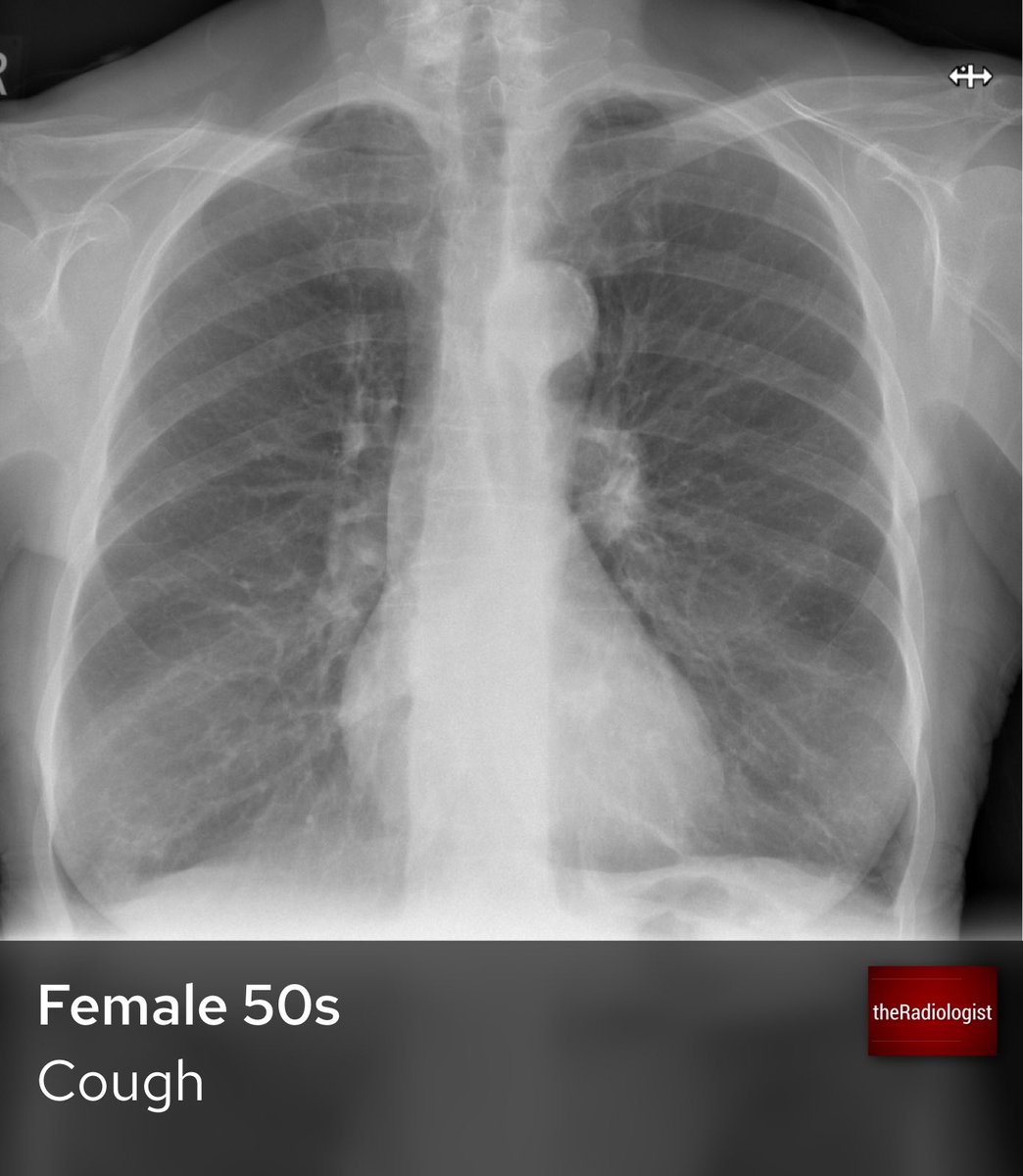 A female in her 50s presents to her GP with a few month history of cough and has a Chest X-Ray. Is it normal?