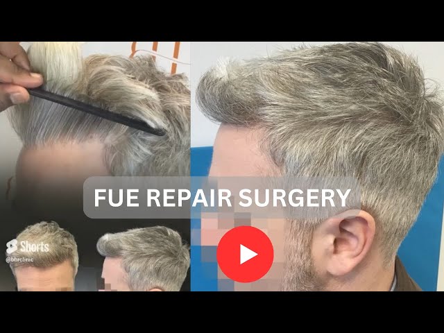 BHRClinic's tweet image. This patient had poor previous #surgery resulting in poor, sparse and pluggy growth. Dr. #Bisanga punched out the offending #grafts and with just over 2,000 grafts made a brand new #hairline for this patient to enjoy! youtu.be/7YmOgh1h2Ig

#hairloss #FUE #hairgoals #alopecia