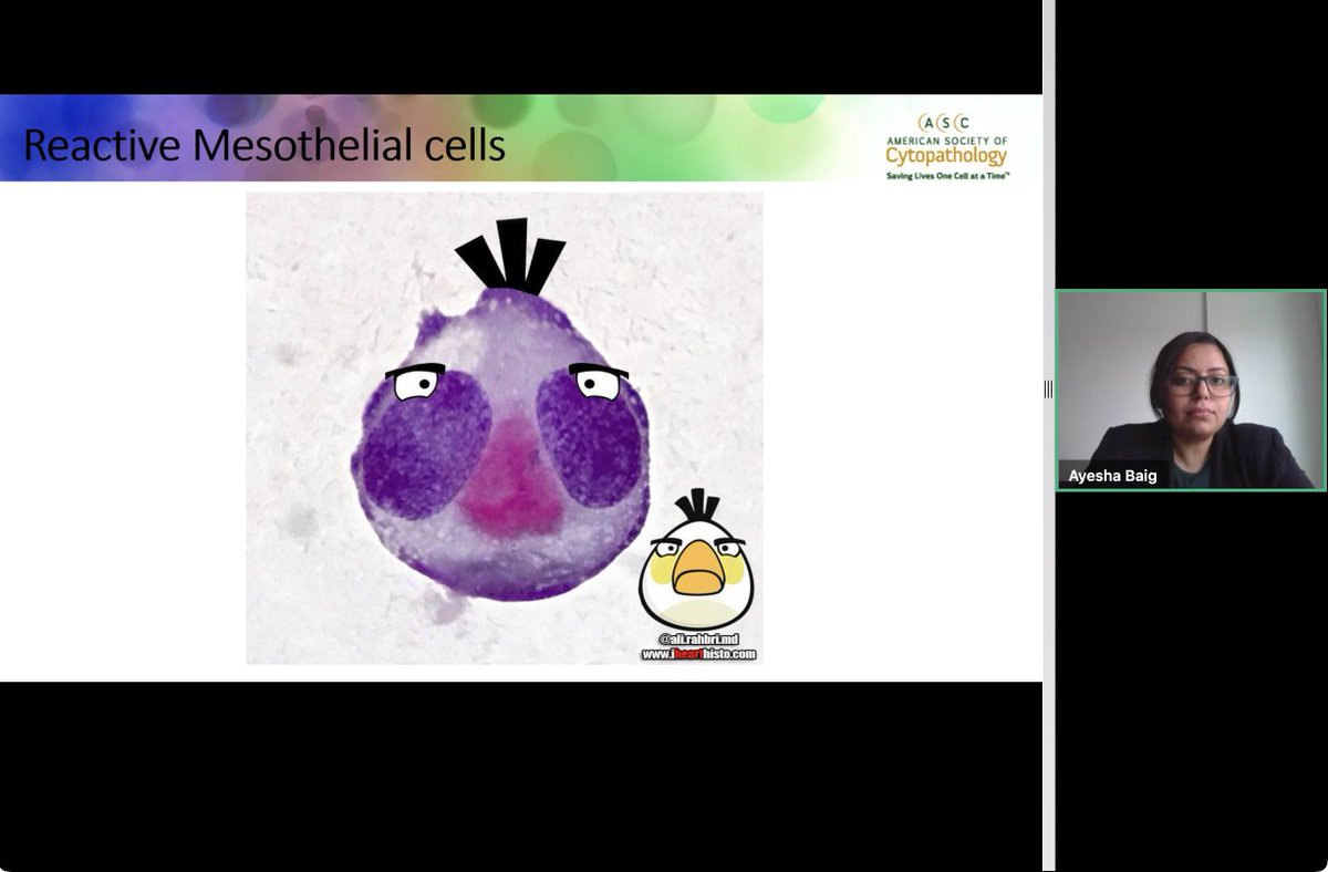 Dr. Ayesha Baig <a href="/ABaigMD/">Ayesha Baig MD MSc FRCPC</a> presenting on serous effusion cytopathology for the <a href="/cytopathology/">Cytopathology.org</a> Crash Course! Love her slides on the (too) many faces of mesothelial cells and Angry Bird reactive meso! #cytocrashcourse #cytopath