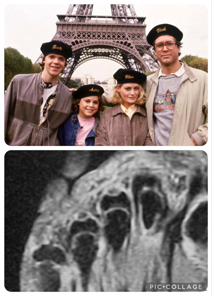 Getting some real “National Lampoon’s European Vacation chapeau” vibe from these metatarsal heads