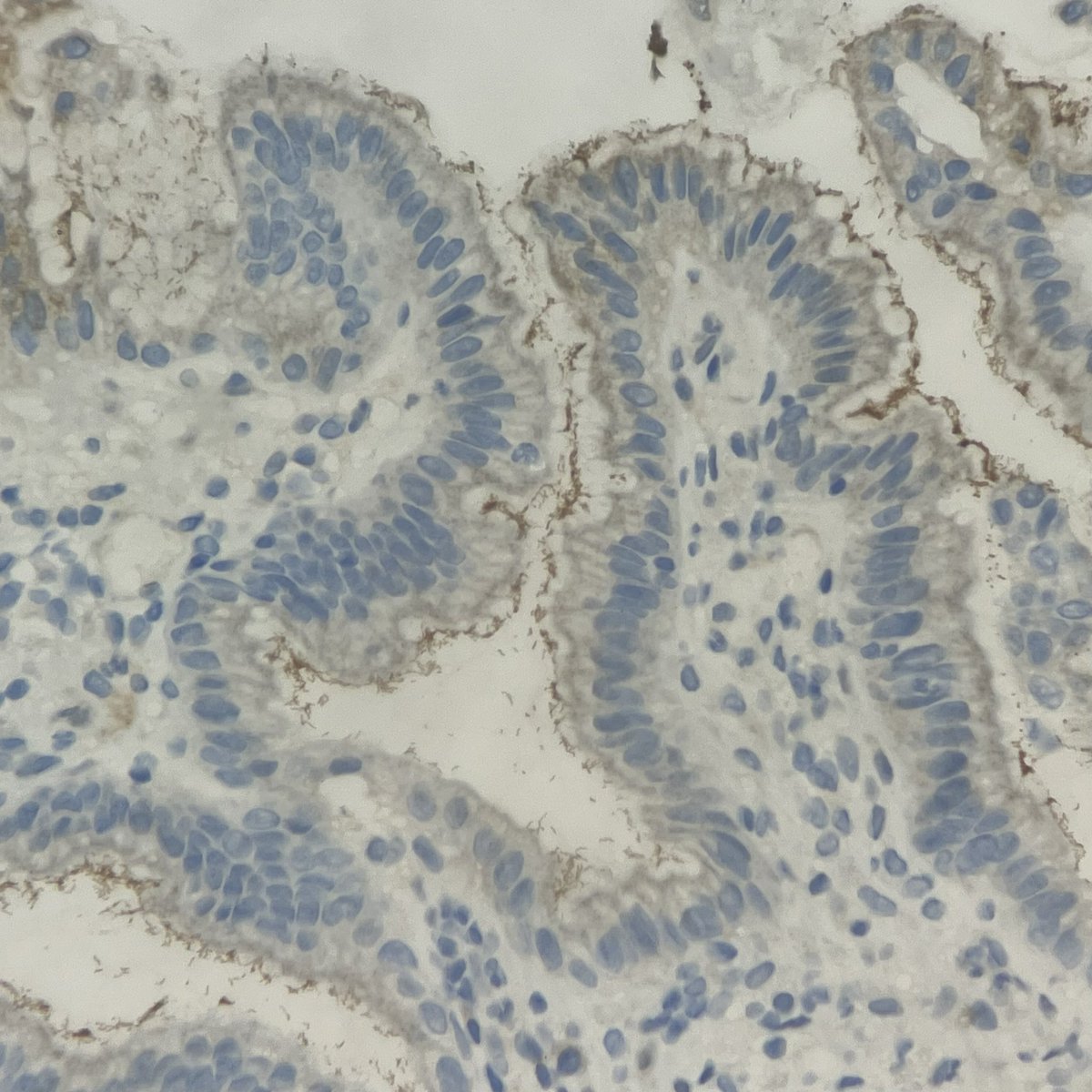 Jackson Barbosa, MD (@jcksalex) on Twitter photo Just a random useless observation. But SOX10 IHC seems to nicely cross-react with H. pylori. Just a random useless observation. But SOX10 IHC seems to nicely cross-react with H. pylori.