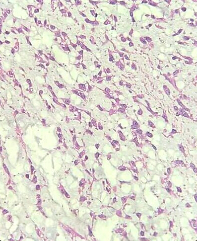 thejourneymate's tweet photo. Extraskeletal Myxoid Chondrosarcoma (EMC) is a rare tumor with an estimated incidence of <3% among of all soft-tissue sarcomas. It is characterized by a multinodular architecture, abundant myxoid matrix, and malignant chondroblast-like cells arranged in cords. (1/3). 
#BSTPath https://t.co/zI6DWqUS3n