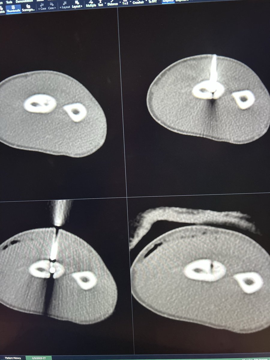 KeeganDurbin's tweet photo. I’ve finally beaten you. After nearly 2 years with you in my arm I can almost say your out of my life. This tumor has taken so much away from my life but i’m finally ready to play this amazing game again. The journey was brutal but I’m back and stronger then ever. #rollrams https://t.co/98QD9EJoQ8